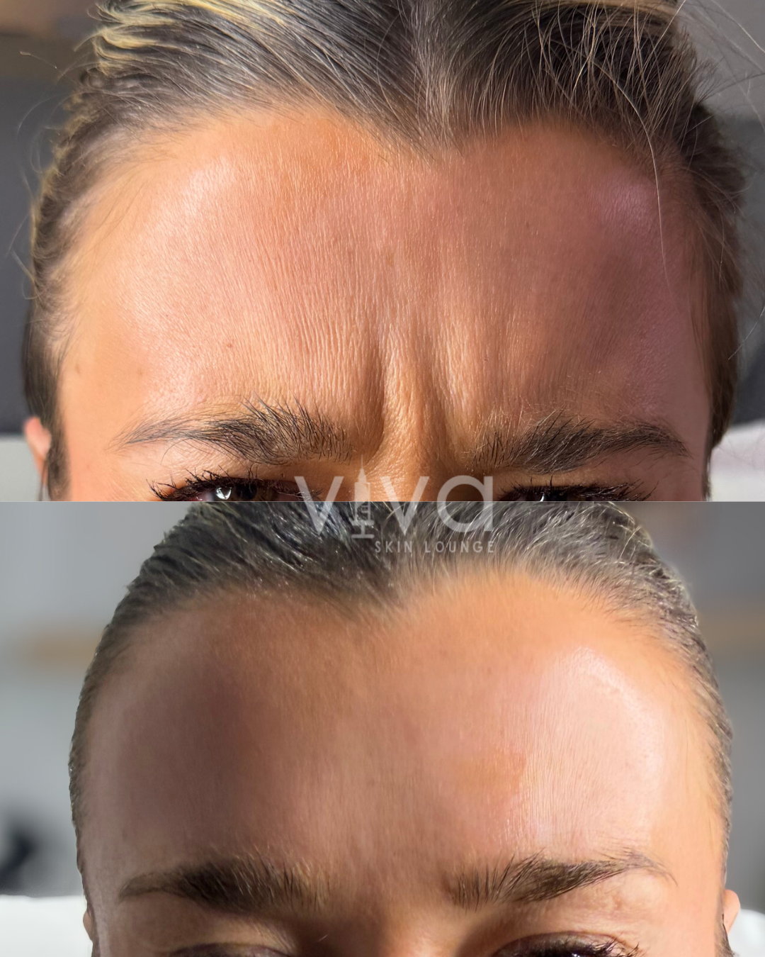Frontalis Before + After
