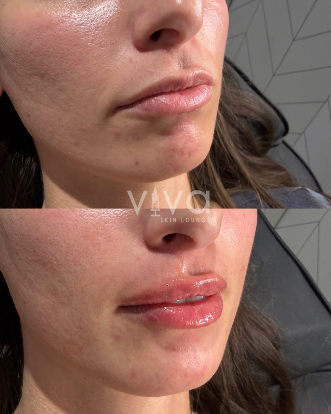 Lips Before + After